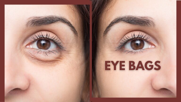 undereye bags skin perfect brothers