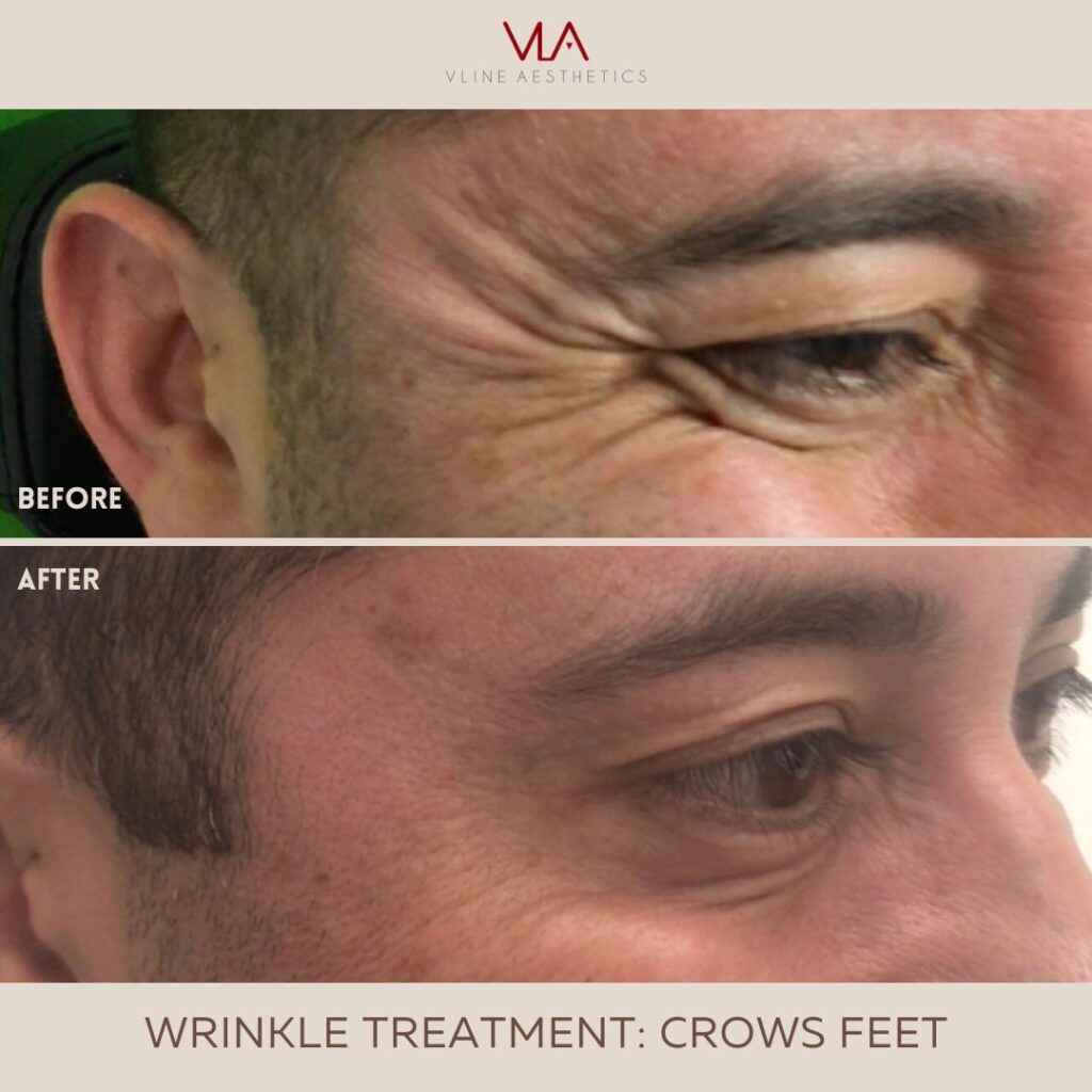 crows feet wrinkles skin perfect brothers