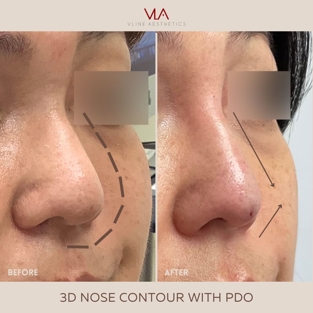 nose contour with pdo threads and filler