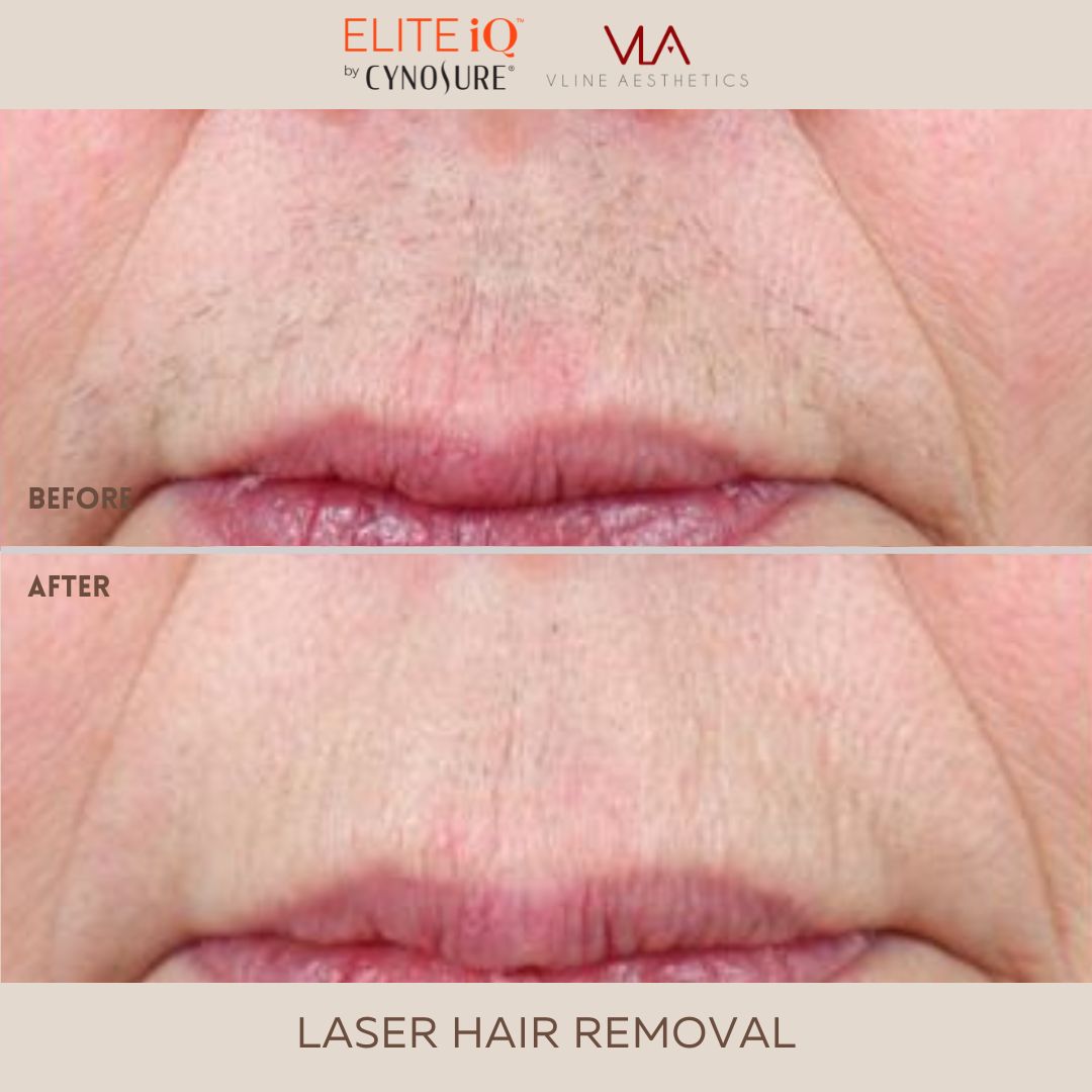 The Elite IQ Laser V LINE AESTHETICS