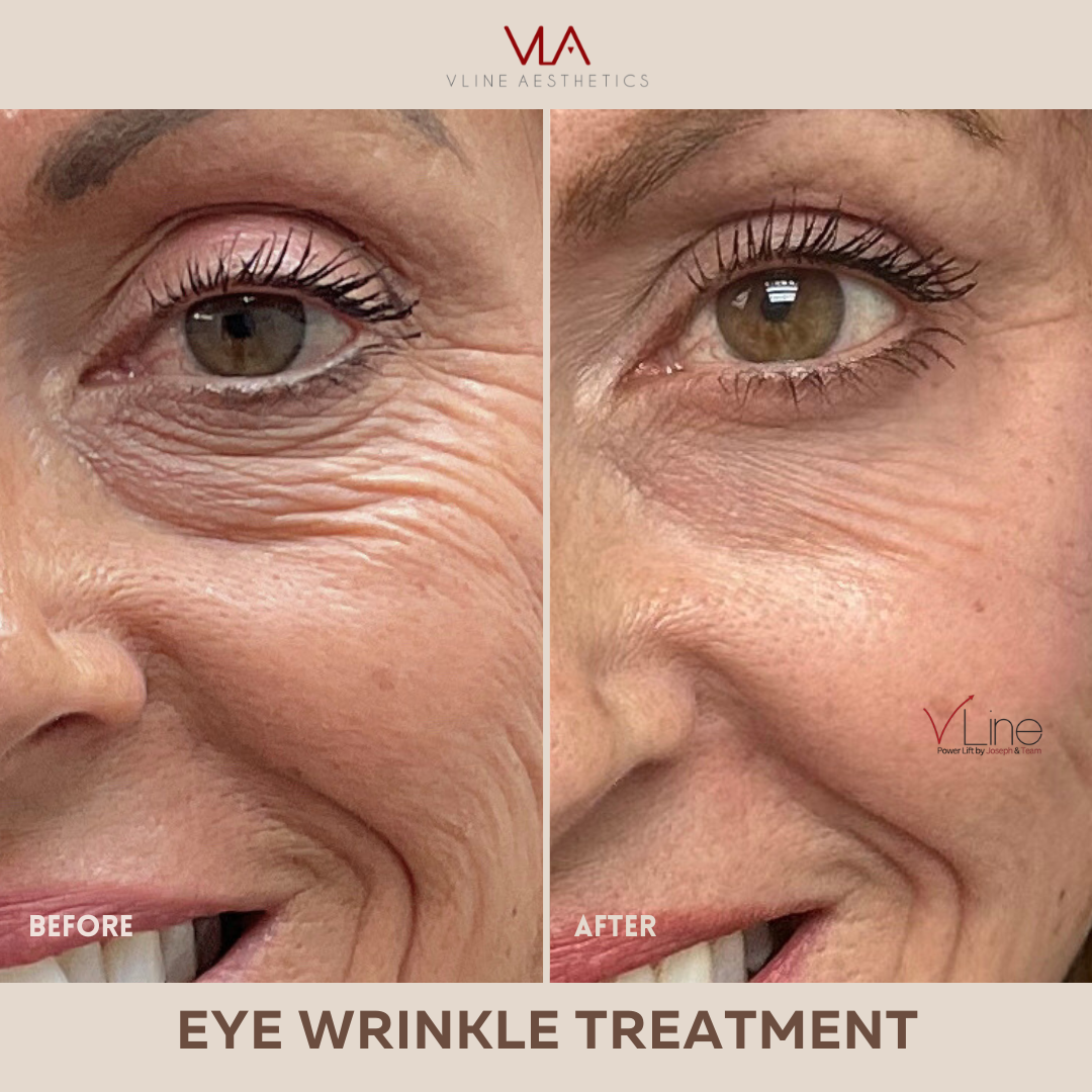 Wrinkle treatment