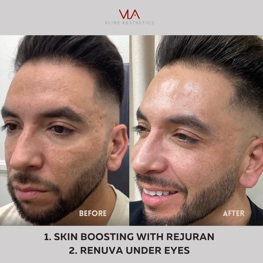Skin boosting with rejuran