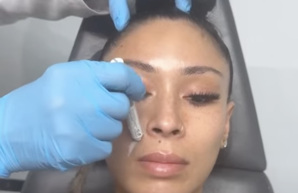 Regenerative Filler Results