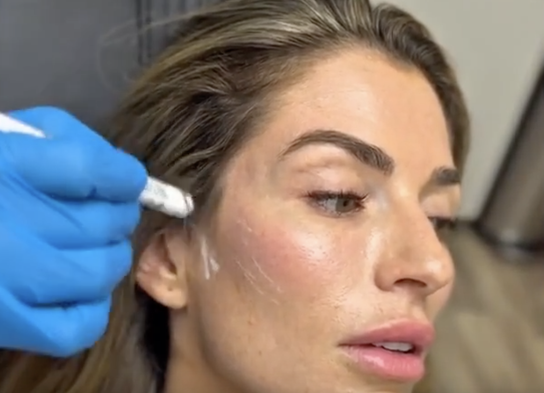 V-lift Technique | Prevent Pillow Face