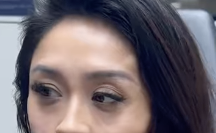 V-Lift with Radiesse